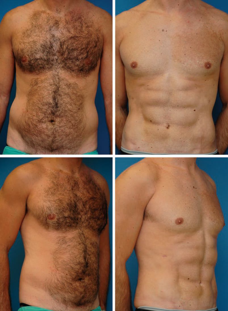 жир на животе и груди у мужчин фото 42